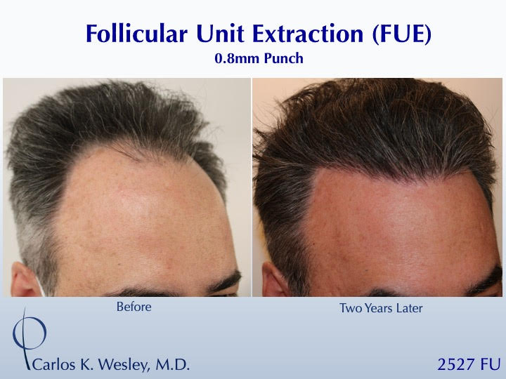 52-year-old man underwent a follicular unit extraction(FUE) session with Dr. Carlos K. Wesley in which a total of 2527 
 
CARLOS K. WESLEY, MD (NYC)...