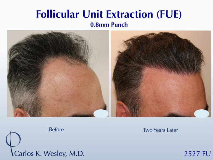 52-year-old man underwent a follicular unit extraction(FUE) session with Dr. Carlos K. Wesley in which a total of 2527 
 
CARLOS K. WESLEY, MD (NYC)...