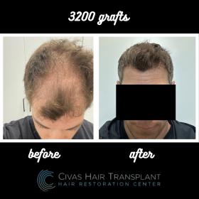 Procedure: FUE Hair Transplant 
Number of grafts: 3200 Grafts