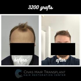 Procedure: FUE Hair Transplant 
Number of grafts: 3200 Grafts