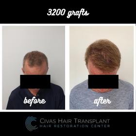 Procedure: FUE Hair Transplant 
Number of grafts: 3200 Grafts