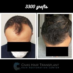 Procedure: FUE Hair Transplant 
Number of grafts: 3300 Grafts