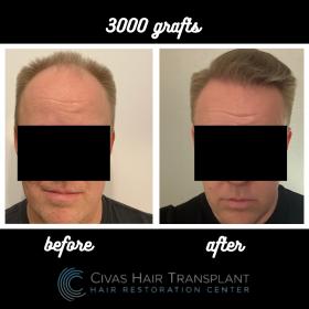 Procedure: FUE Hair Transplant 
Number of grafts: 3000 Grafts