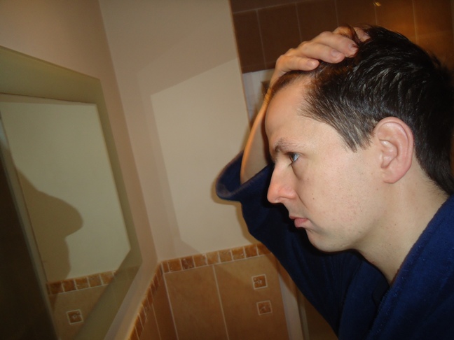 Receding Hairline What Do You Think Baldtruthtalk Com