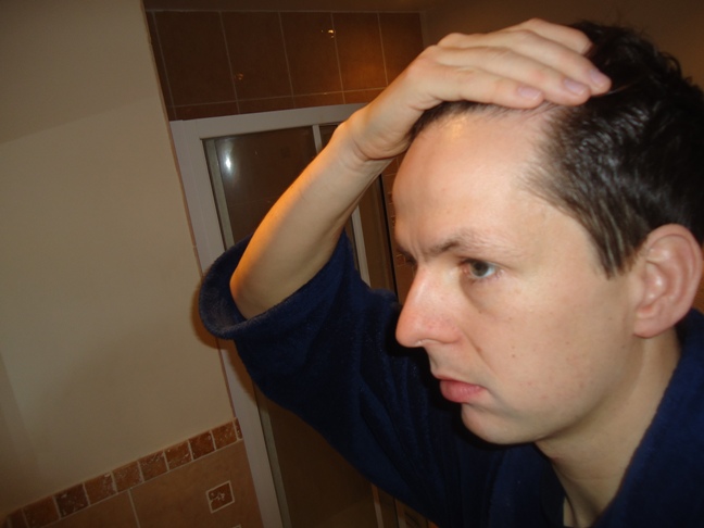 Receding Hairline What Do You Think Baldtruthtalk Com