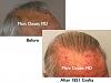 Click image for larger version

Name:	Hair Transplant Slides6.350.jpg

Size:	70.2 KB
ID:	36129