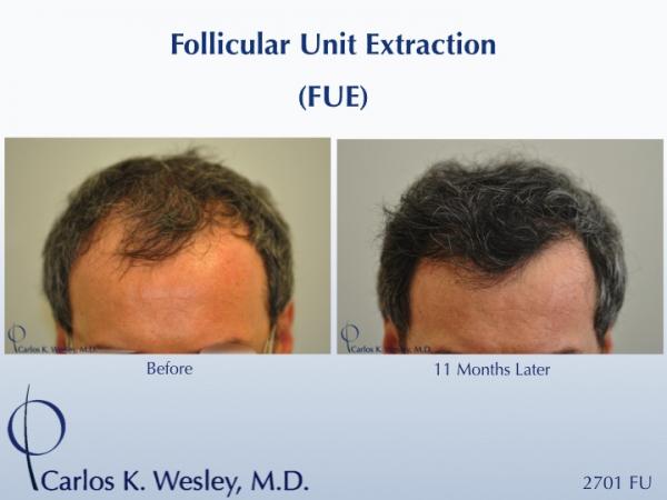 Follicular Unit Extraction (FUE) with Dr. Carlos K. Wesley in New York City. Before/After 2701 FUE grafts using a combination of 0.8mm and 0.9mm...