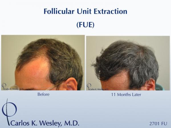 Follicular Unit Extraction (FUE) with Dr. Carlos K. Wesley in New York City. Before/After 2701 FUE grafts using a combination of 0.8mm and 0.9mm...