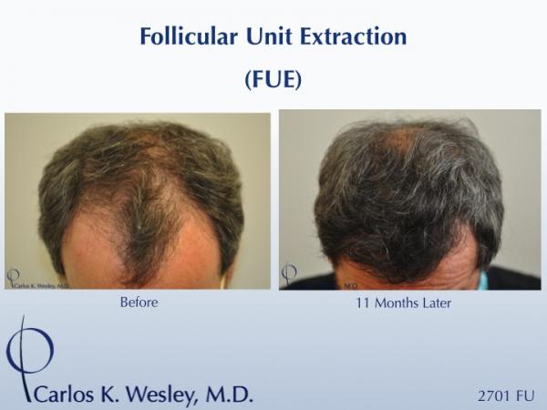 Follicular Unit Extraction (FUE) with Dr. Carlos K. Wesley in New York City. Before/After 2701 FUE grafts using a combination of 0.8mm and 0.9mm...