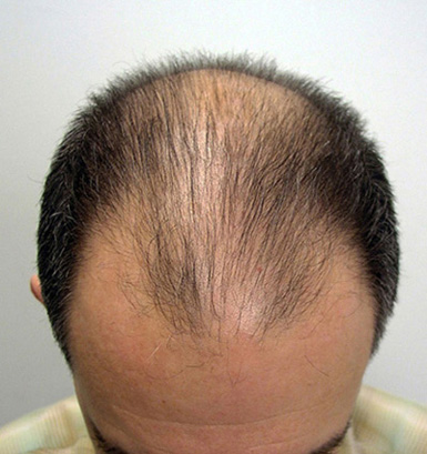 Before hair transplantation