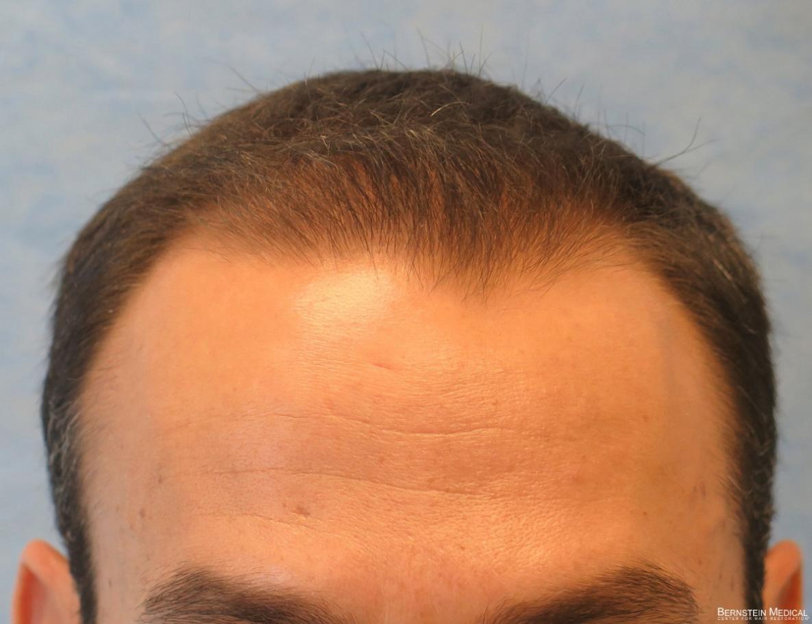 Click image for larger version

Name:	1d_after-hair-transplant_acb.jpg

Size:	87.3 KB
ID:	47615