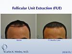 Before and 13 months after FUE with Carlos K. Wesley (NYC).