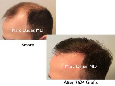 Click image for larger version

Name:	Hair Transplant Slides copy9.002.jpg

Size:	11.9 KB
ID:	43496