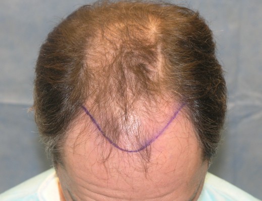 Click image for larger version

Name:	08_position-of-hairline-top-view.jpg

Size:	54.0 KB
ID:	7202