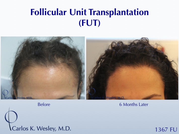 Female Hair Restoration