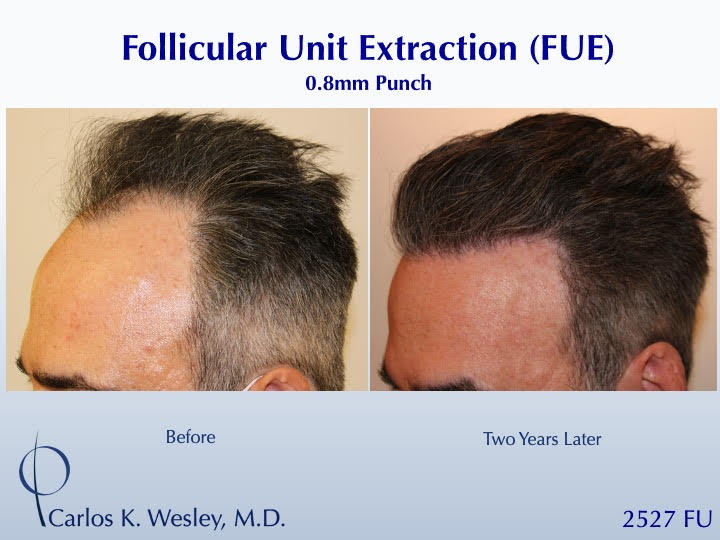 52-year-old man underwent a follicular unit extraction(FUE) session with Dr. Carlos K. Wesley in which a total of 2527 
 
CARLOS K. WESLEY, MD (NYC)...