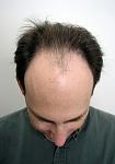 Before hair restoration with Dr. True