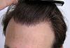 Hairline close-up after one 3513 FUT by Dr. True