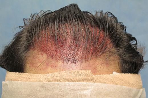 Click image for larger version

Name:	1c immediate post-op hairline.jpg

Size:	29.0 KB
ID:	35754