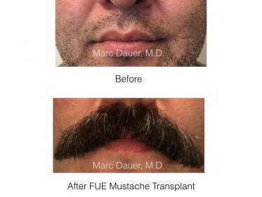 fue mustache hair transplant