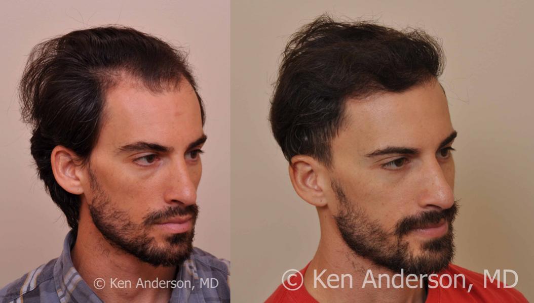 Jason Nicola	 
Norwood 3 
Age: 34 
Surgeon: Dr. Ken Anderson, MD 
Location: Atlanta, Georgia 
	 
Clinical History: 
Jasons initial consultation with...