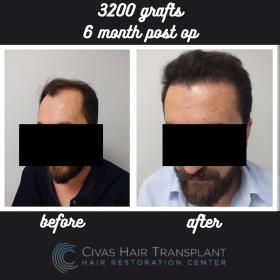 Procedure: FUE Hair Transplant 
Number of grafts: 3200 Grafts 
Results: 6 Months Post-op