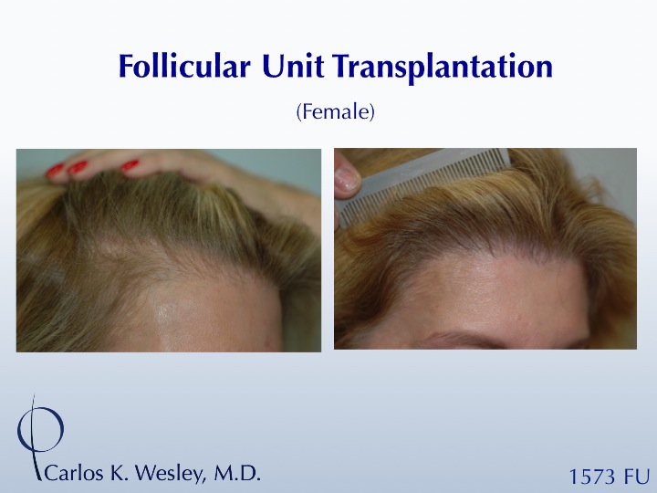 Before/After of a female patient undergoing a 1573 graft session with the NYC practice of Dr. Carlos K. Wesley. 
 
An interactive before/after image...