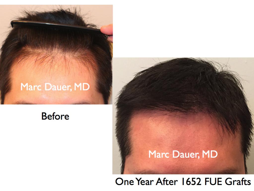 Click image for larger version

Name:	Hair Transplant Slides8.335.jpg

Size:	69.4 KB
ID:	35940