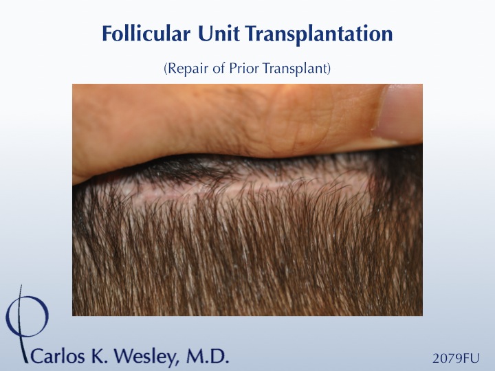 Softening a "pluggy" appearing hairline can be achieved in a single session. This 42-year-old male had previously undergone two hair transplants that...