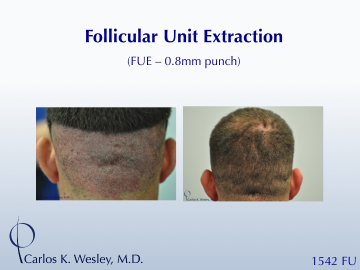 FUE with 0.75mm punch 
A video of this patient's experience can be viewed here: 
www.drcarloswesley.com/videos_16.html