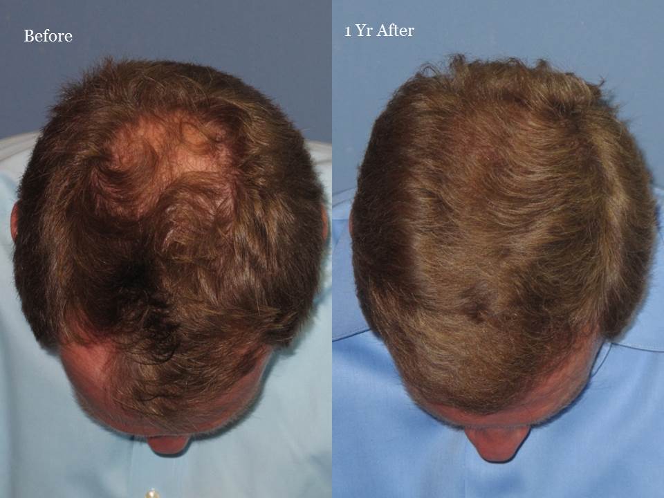 Dr. Paul Shapiro, MD 
FUT 2125 grafts 
12 months post-op