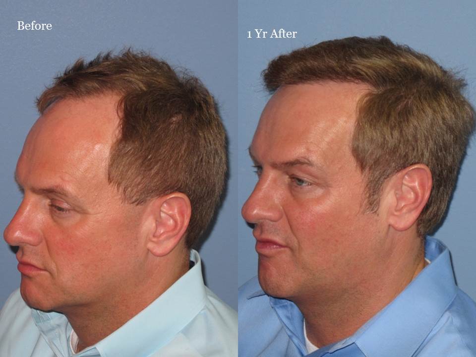 Dr. Paul Shapiro, MD 
FUT 2125 grafts 
12 months post-op