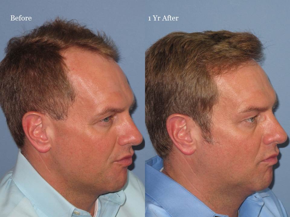 Dr. Paul Shapiro, MD 
FUT 2125 grafts 
12 months post-op