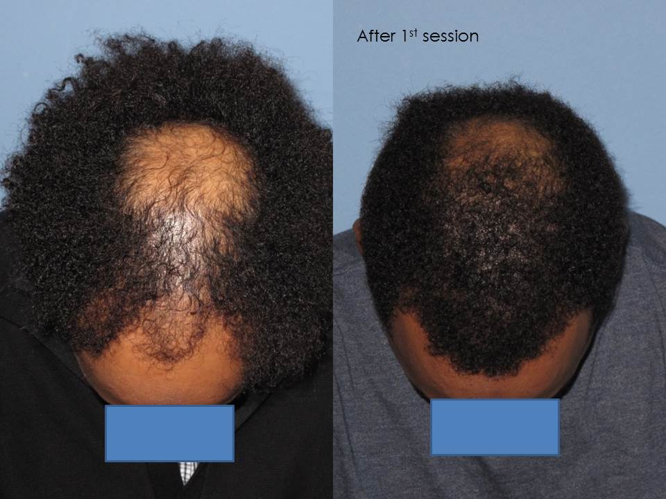 Paul Shapiro, MD 
1st Session FUT = 2339 grafts 
2nd Session FUT = 1706 grafts 
Total for two = 4045 grafts