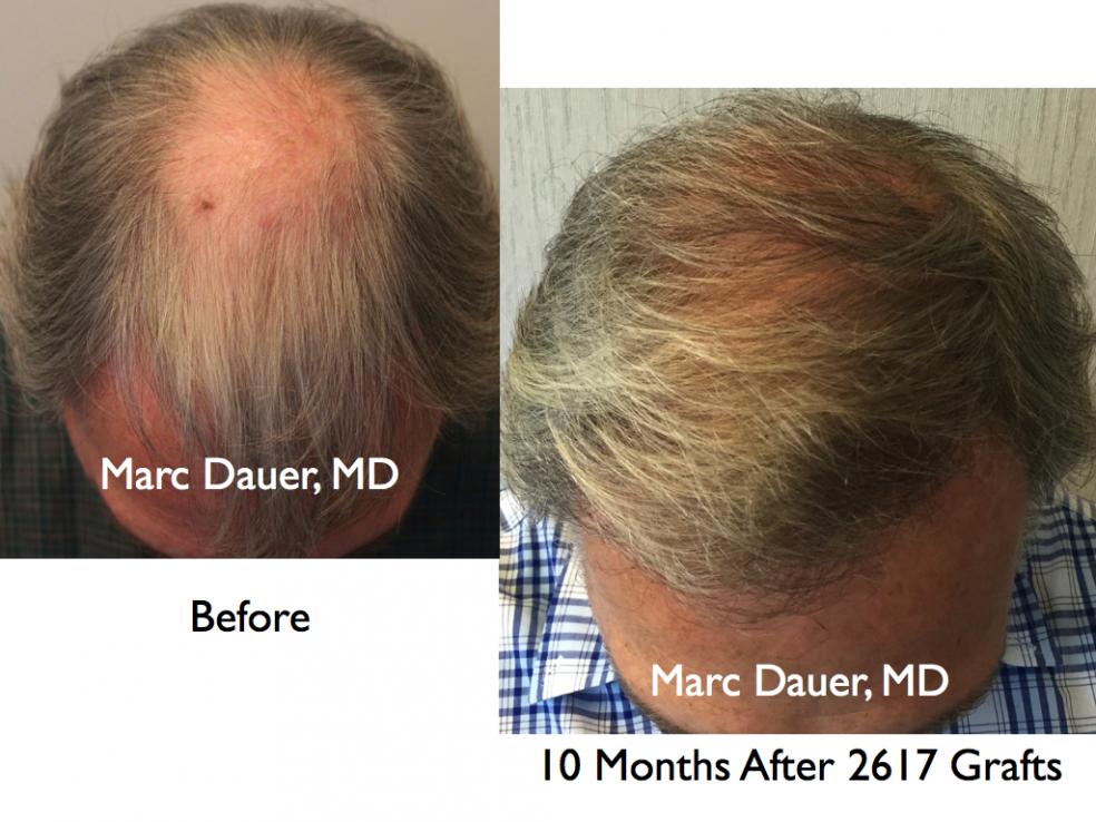 Click image for larger version

Name:	Hair Transplant Slides2.318.jpg

Size:	91.3 KB
ID:	35732