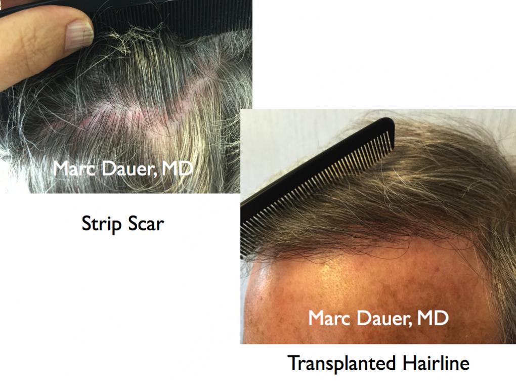 Click image for larger version

Name:	Hair Transplant Slides2.317.jpg

Size:	90.0 KB
ID:	35734