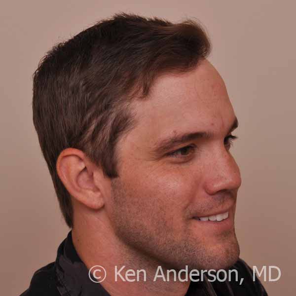 Dr. Ken Anderson - 32 year old Norwood 3 - ARTAS and PRP with ACell - 14 month post-procedure results