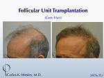Before/After a treatment with 3976 grafts by Dr. Carlos K. Wesley in New York City. 
 
A video of this patient's transformation may be viewed here:...