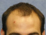 Click image for larger version

Name:	thumbs_03_before-hair-transplant.jpg

Size:	14.8 KB
ID:	24956