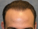 Click image for larger version

Name:	thumbs_04_after-1st-hair-transplant.jpg

Size:	14.8 KB
ID:	24957