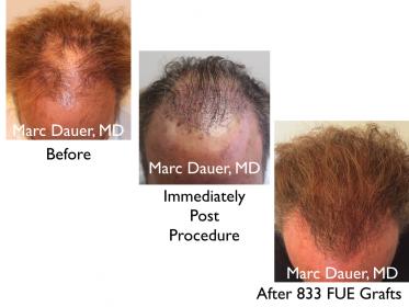 Click image for larger version

Name:	Hair Transplant Slides copy45.004.jpg

Size:	15.3 KB
ID:	46955