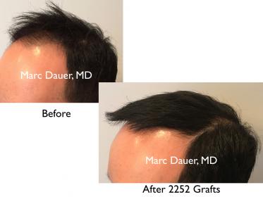 Click image for larger version

Name:	Hair Transplant Slides copy30.002.jpg

Size:	11.7 KB
ID:	45860