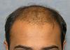 Click image for larger version

Name:	03_before-hair-transplant.jpg

Size:	50.5 KB
ID:	6537