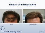 A 2116 graft session in Dr. Wesley practice in NYC.  
Wavy brown hair provides some of the best hair characteristics for more scalp coverage.