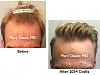 Click image for larger version

Name:	Hair Transplant Slides.707.jpg

Size:	73.3 KB
ID:	41025