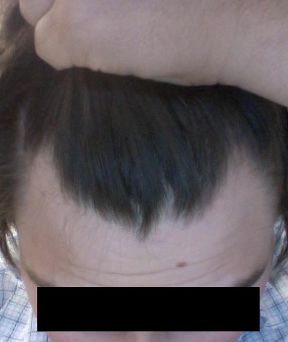 Click image for larger version

Name:	hairlinedeepangle2012.jpg

Size:	33.0 KB
ID:	16468