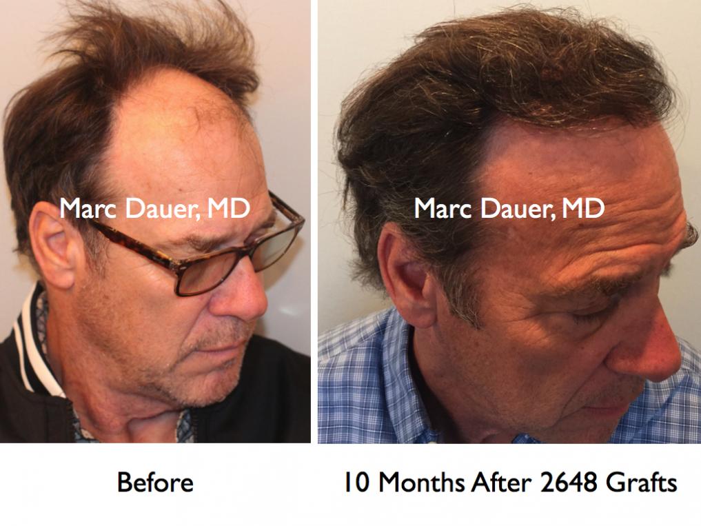 Click image for larger version

Name:	Hair Transplant Slides.426.jpg

Size:	91.5 KB
ID:	36982