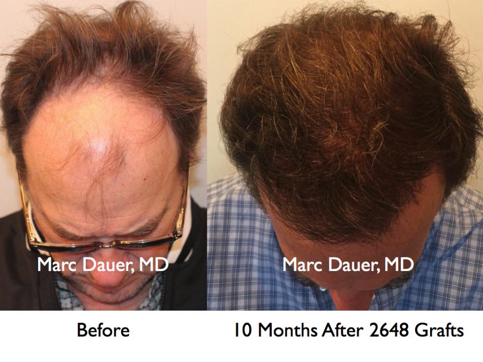 Click image for larger version

Name:	Hair Transplant Slides.427.jpg

Size:	91.6 KB
ID:	36983