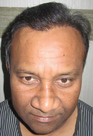 Click image for larger version

Name:	Darling Buds hair transplant Chandigarh India (1).JPG

Size:	55.1 KB
ID:	25999