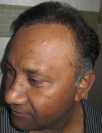 Click image for larger version

Name:	Darling Buds hair transplant Chandigarh India (2).JPG

Size:	52.8 KB
ID:	26000